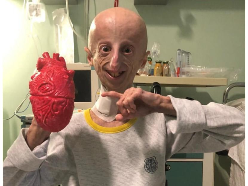 Sammy Basso, Penderita Progeria Tertua Meninggal pada Usia 28 Tahun